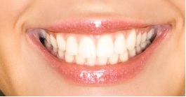 White Fillings