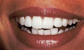 Cosmetic Dental Bonding