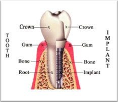 Cosmetic Dental Implants