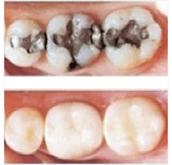 Dental Fillings
